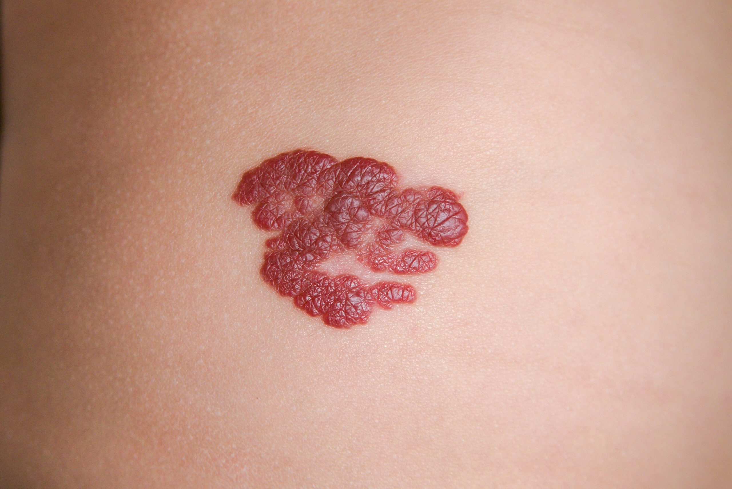 Infantile Hemangioma red birthmark (also called strawberry mark)