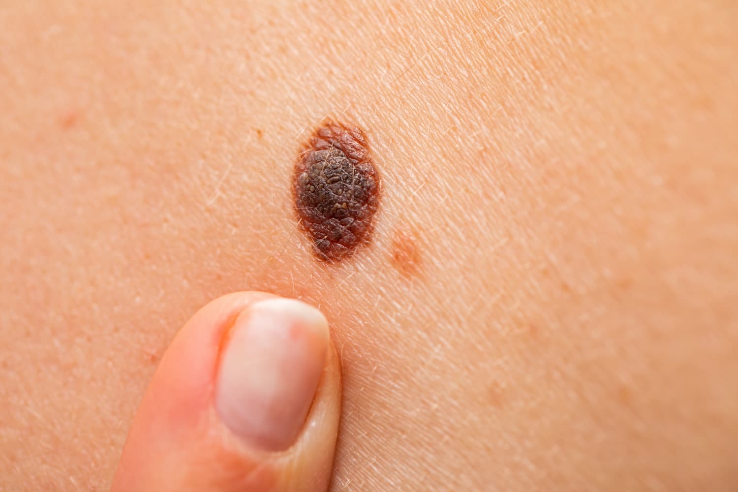 Skin Moles Types