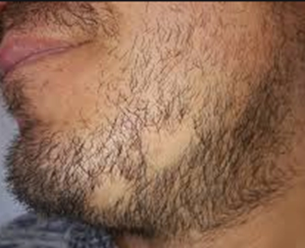 alopecia-beard