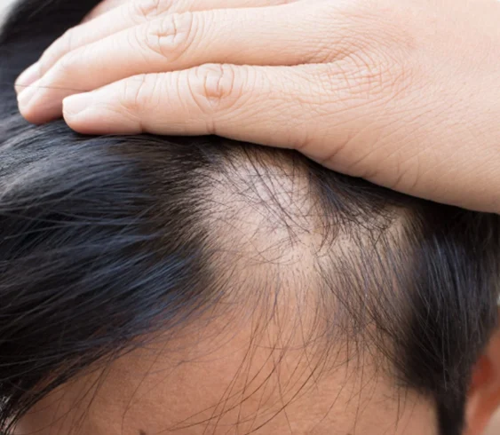 Alopecia areata - MySkinDoctor