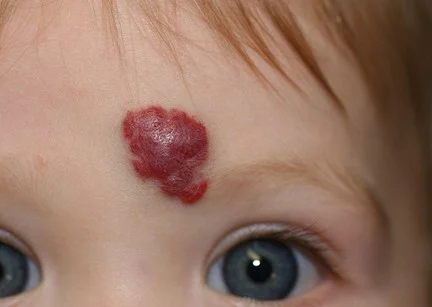 haemangioma haemangioma