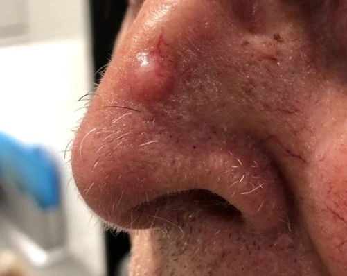 basal cell carcinoma nose scar