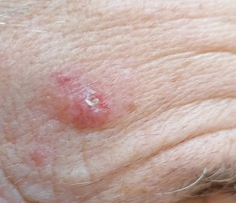 Basal cell carcinoma