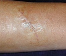 Arm scar