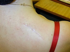 Back scar