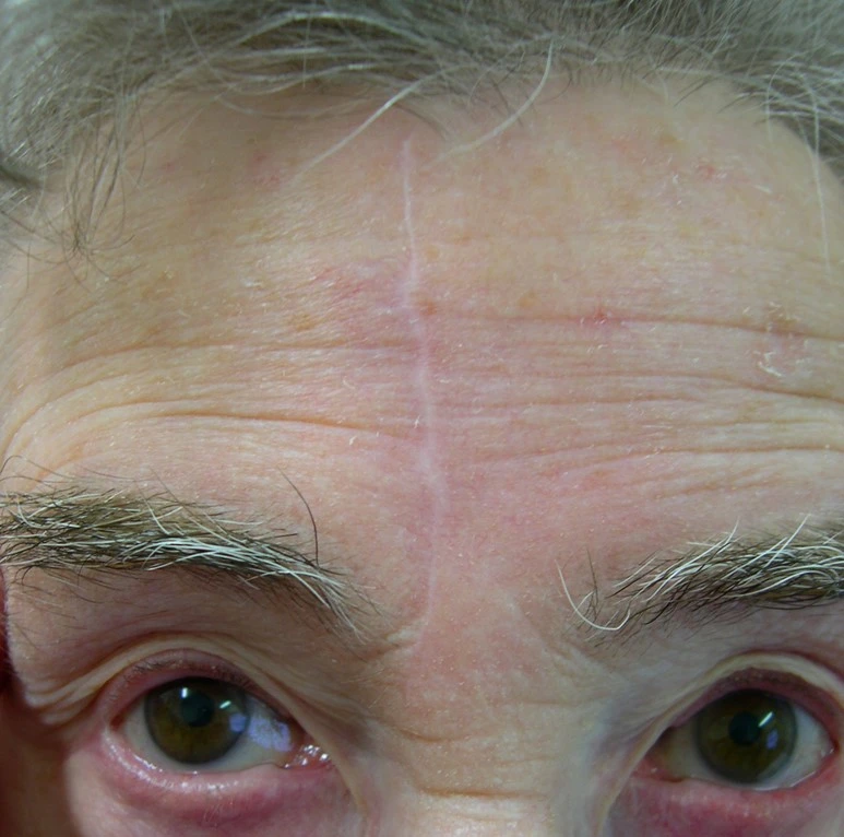 forehead scar