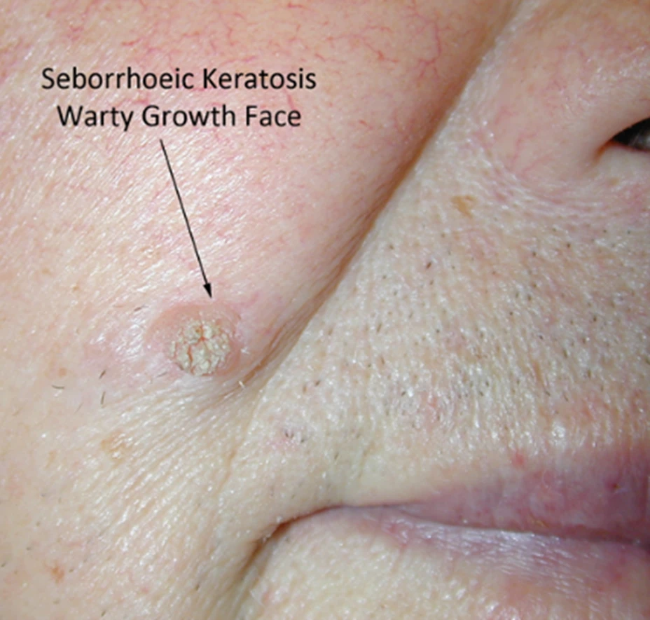 Seborrheic Keratosis Irritated Photo Skin Disease Pictures